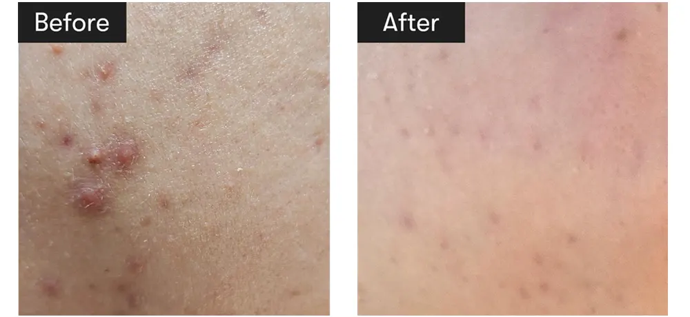 Reedle shot 300, VT COSMETICS Reedle Shot 300 Essence 30mL