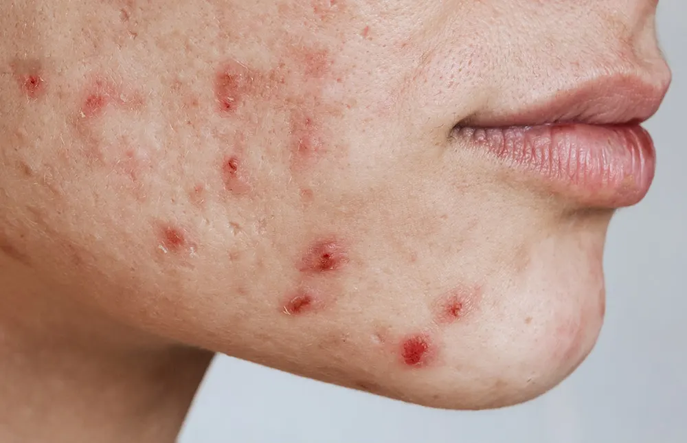 The best acne serum, SBEDT Red Heartleaf BHA-Lino Relief Ampoule