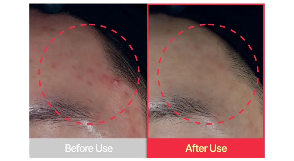 Acne Treatment Cream, SUNGBOON EDITOR Red Heartleaf BHA-Lino Trouble Relief Soothing Cream 50ml