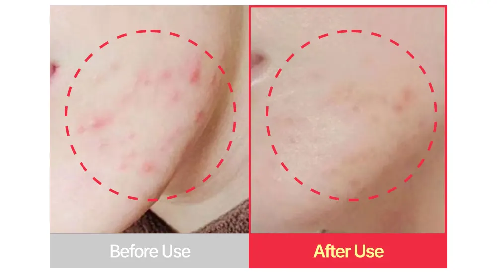 Acne Treatment Cream, SUNGBOON EDITOR Red Heartleaf BHA-Lino Trouble Relief Soothing Cream 50ml