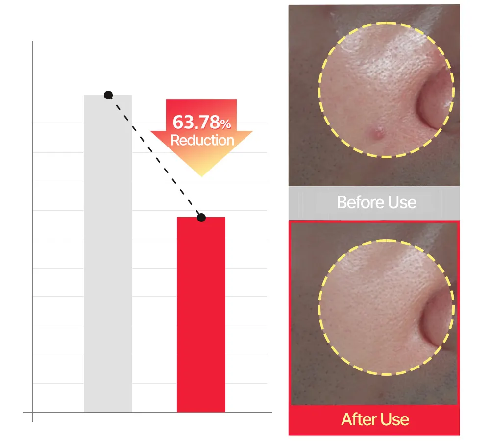 Acne Treatment Cream, SUNGBOON EDITOR Red Heartleaf BHA-Lino Trouble Relief Soothing Cream 50ml