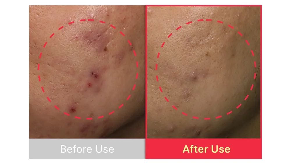 The best acne serum, SBEDT Red Heartleaf BHA-Lino Relief Ampoule