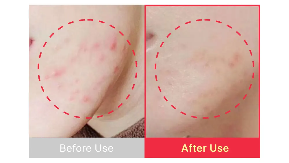 The best acne serum, SBEDT Red Heartleaf BHA-Lino Relief Ampoule