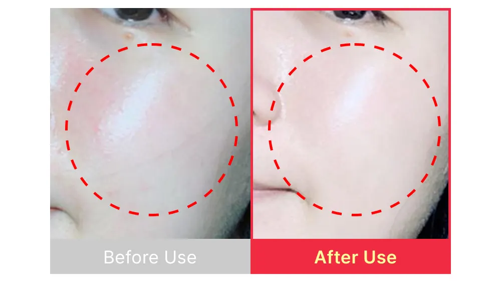 The best acne serum, SBEDT Red Heartleaf BHA-Lino Relief Ampoule