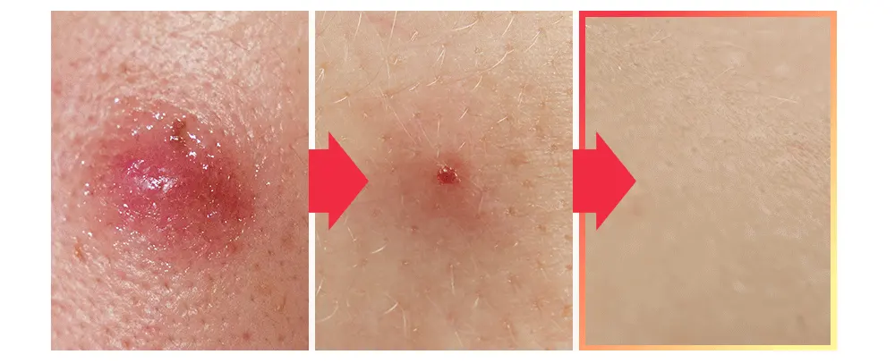 The best acne serum, SBEDT Red Heartleaf BHA-Lino Relief Ampoule