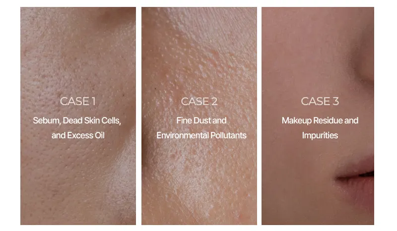 Face Wash for Acne, EASYDEW Clear BHA Cleanser 100ml