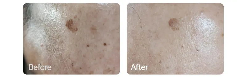 Hyperpigmentation serum, EASYDEW Melatoning Oneday Ampoule