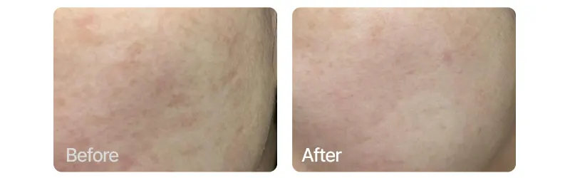 Hyperpigmentation serum, EASYDEW Melatoning Oneday Ampoule