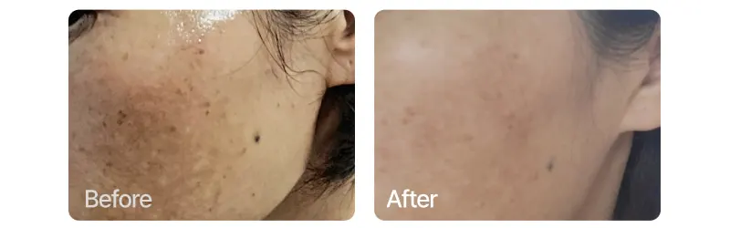 Hyperpigmentation serum, EASYDEW Melatoning Oneday Ampoule