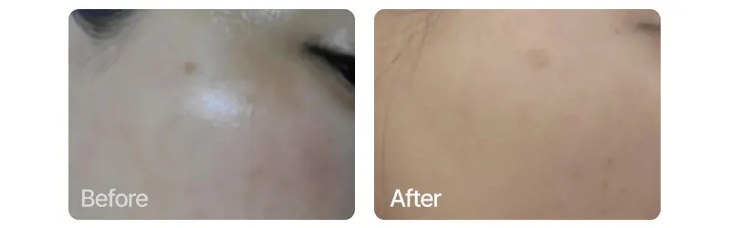 Hyperpigmentation serum, EASYDEW Melatoning Oneday Ampoule