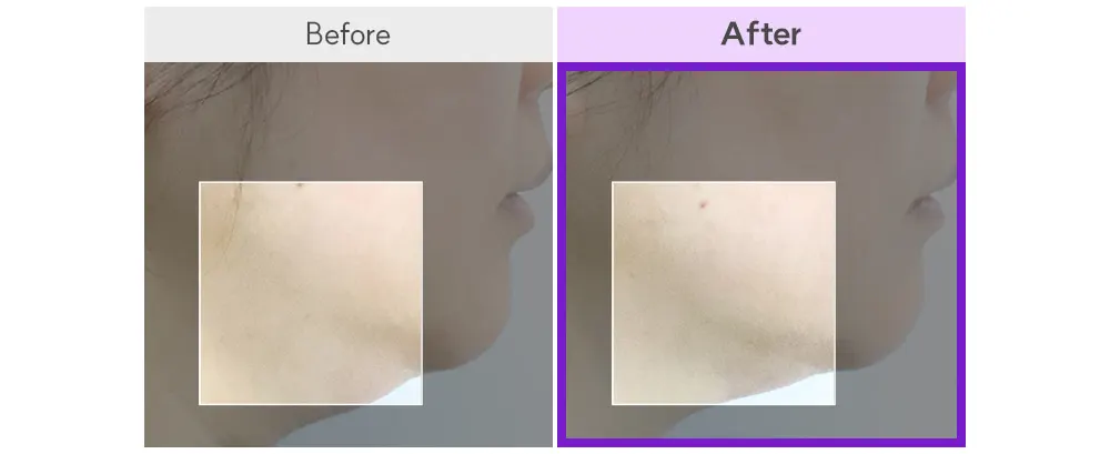 EOA HIFU Fulthera Pro, At-home HIFU Machine Korea Beauty For You EOA HIFU Fulthera Pro, At-home HIFU Machine