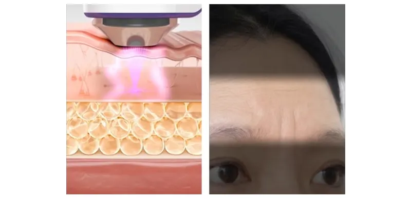 EOA HIFU Fulthera Pro, At-home HIFU Machine Korea Beauty For You EOA HIFU Fulthera Pro, At-home HIFU Machine