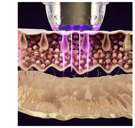 EOA Fultenza, Pore Tightening Device Korea Beauty For You EOA Fultenza, Pore Tightening Device