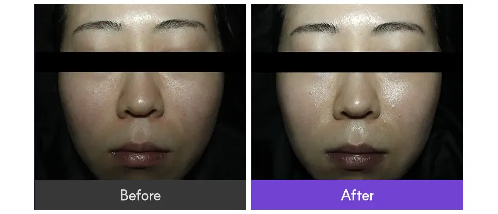 EOA Fultenza, Pore Tightening Device Korea Beauty For You EOA Fultenza, Pore Tightening Device