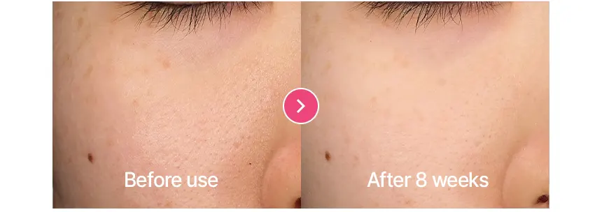 PDRN Hyaluron Dark Spot Pacth05 Korea Beauty For You