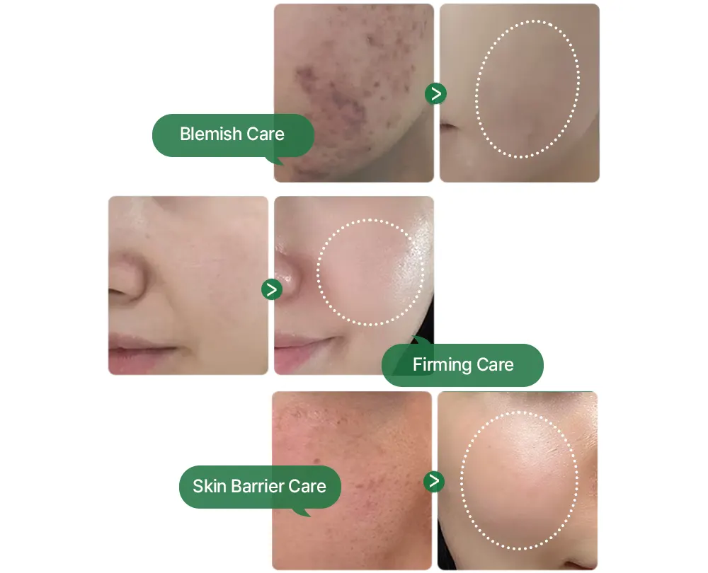 ZIPIDERM EGF Skin Barrier Intensive Cream for Skin Barrier Care