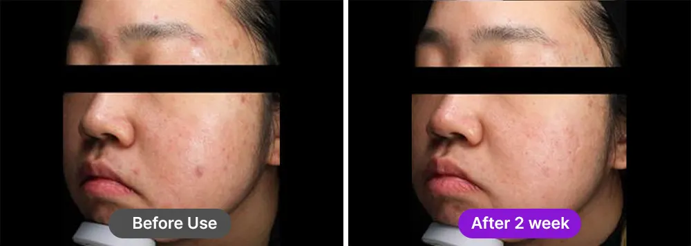 Fation's non-irritating pore cream is specially formulated to soothe redness and care for sensitive, acne-prone skin.