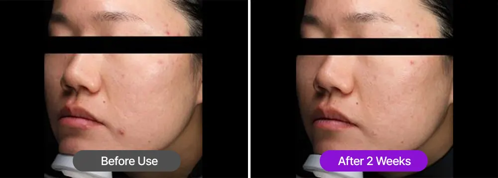 FATION NOSCA9 Pore Enhancing Serum 30ml / 1.01 fl. oz. Korea Beauty For You Clinical test results proving the pore refining serum is safe for acne-prone skin